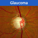 glaucoma-thumbnail