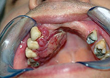 tumor na boca