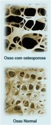 osteoporose1